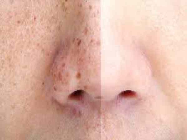 Thuốc chấm tàn nhang chứa Retinoid