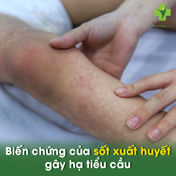 Biến chứng sốt xuất huyết thông thường