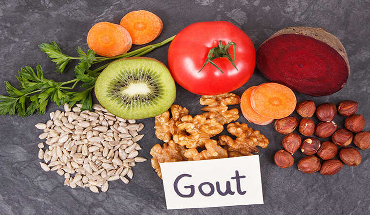 Tổng quan về bệnh Gout