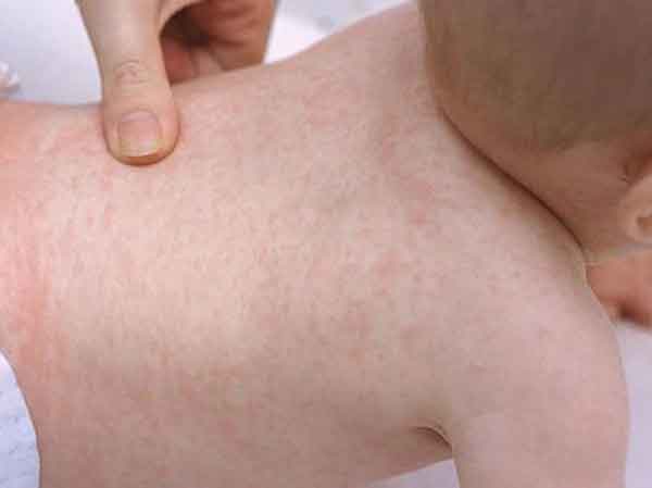 Trẻ bị sởi dễ bị mất nước do sốt cao và có thể không ăn uống tốt