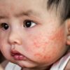 Sởi có thể gây ra các biến chứng nghiêm trọng như viêm phổi, viêm tai giữa
