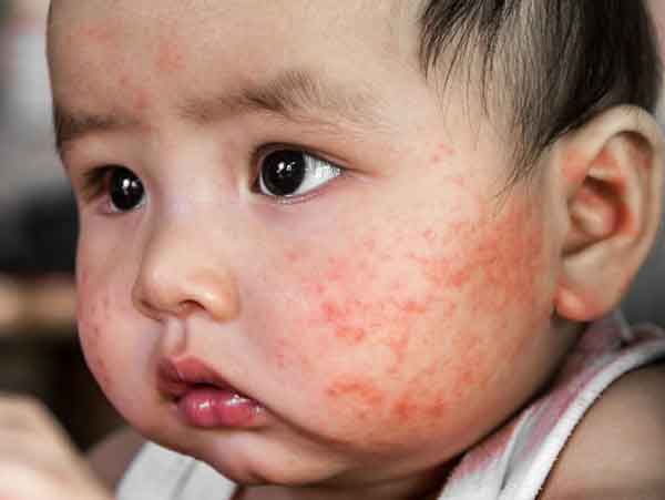 Sởi có thể gây ra các biến chứng nghiêm trọng như viêm phổi, viêm tai giữa